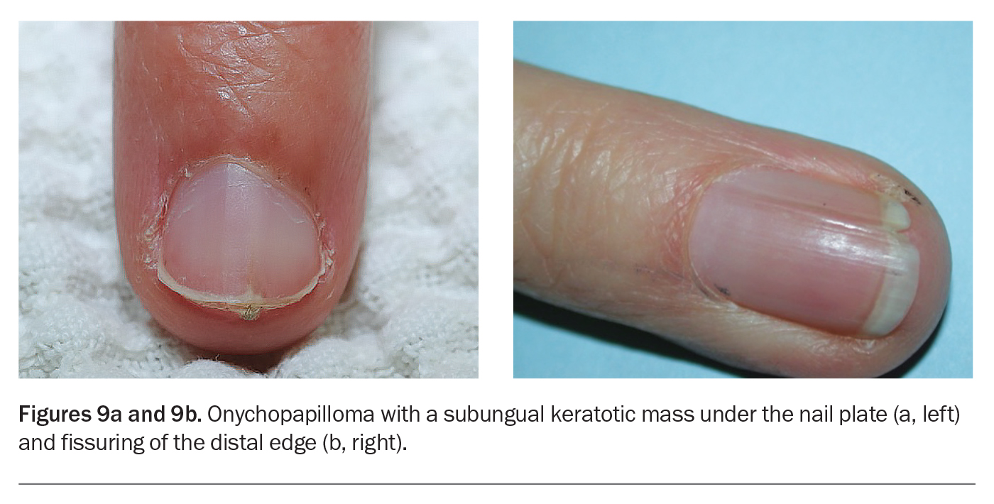 Nail fragility due to nail lichen planus: nail plate thinning,... |  Download Scientific Diagram