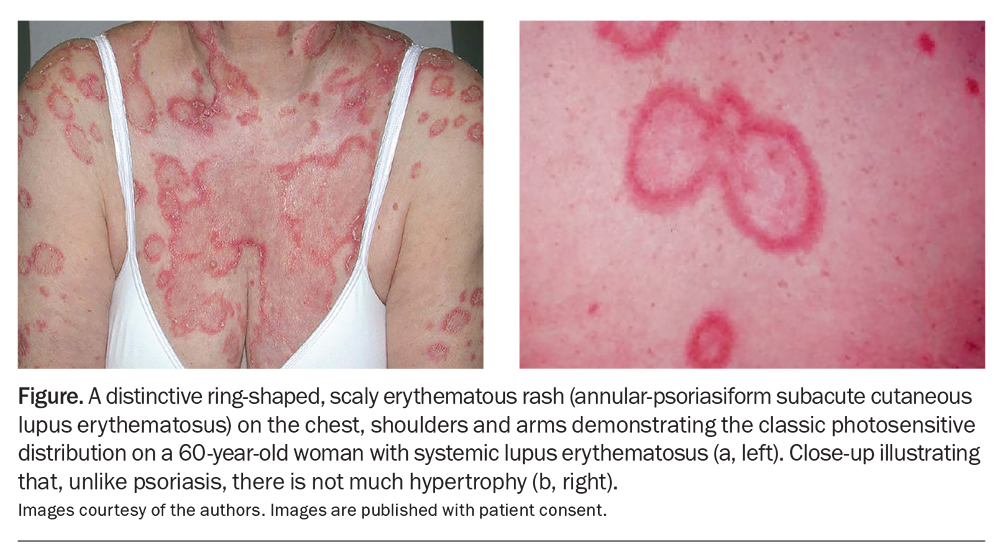 Systemic lupus erythematosus: unmasking the masquerader