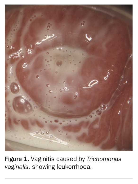 trichomoniasis discharge vaginal