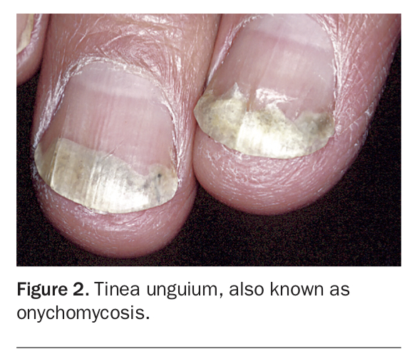 VW Dermatology - Onychomycosis, also known as tinea unguium, is a fungal  infection of the nail. Symptoms may include white or yellow nail  discoloration, thickening of the nail, and separation of the