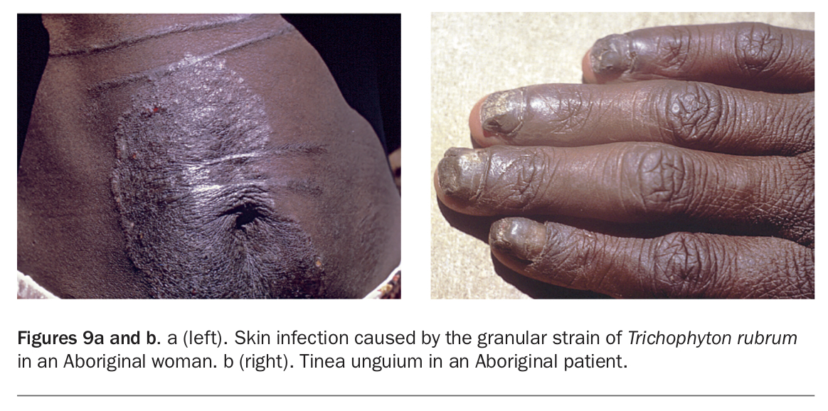 Tinea pedis and Tinea unguium caused by Trichophyton rubrum in an AIDS
