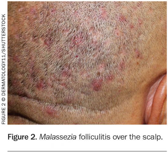 Folliculitis Scalp Folliculitis Scalp