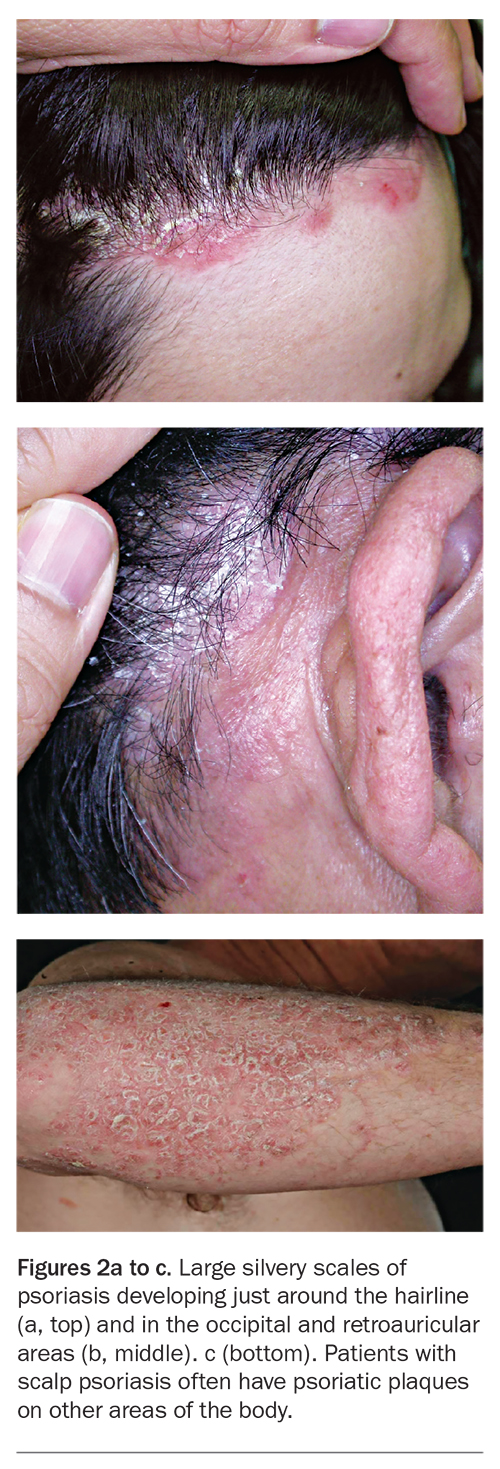 mild dermatitis herpetiformis on face
