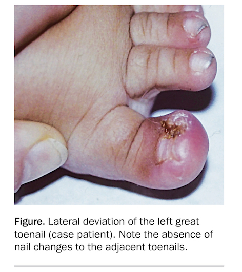 Cureus | Infrequent Pediatric Subungual Injury Diagnosed by Intraoperative  Anatomopathological Material: A Case Report | Article
