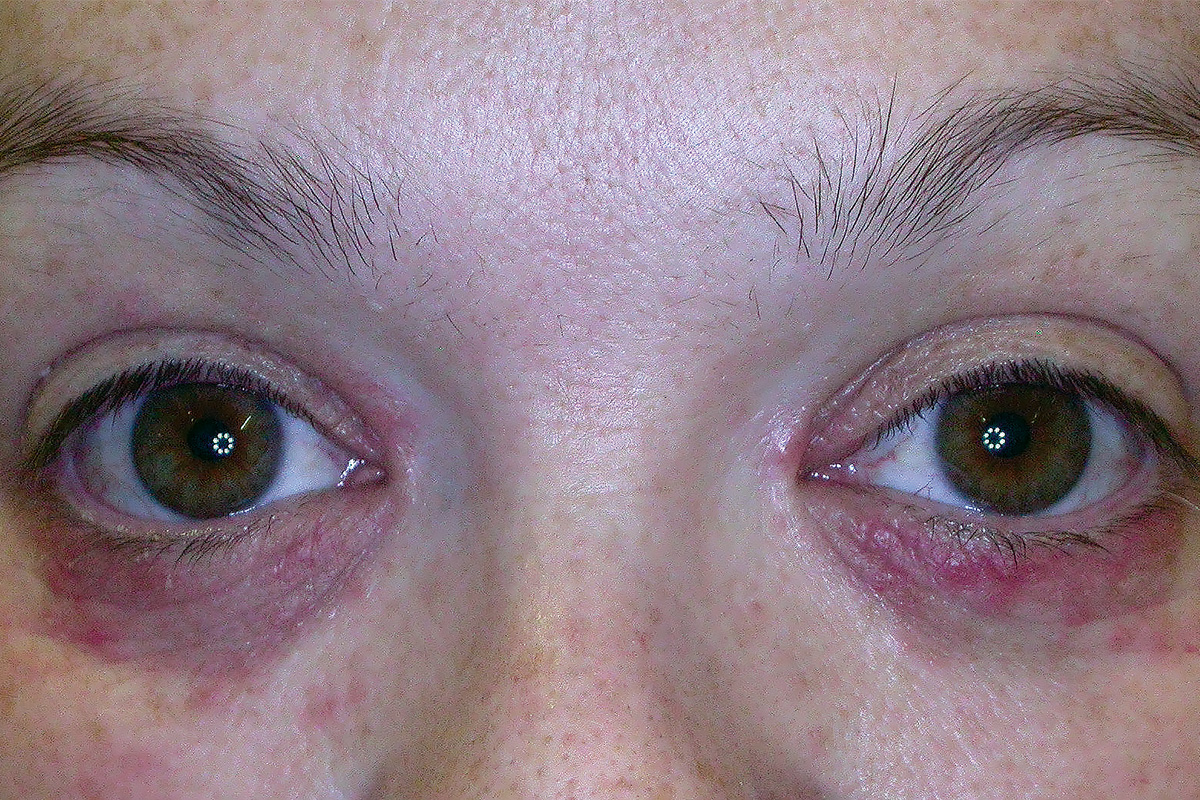 a-woman-with-red-papules-on-the-eyelids-medicine-today