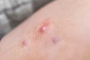 Hidradenitis suppurativa: more than a skin disorder