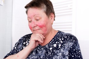Rosacea: an update on classification, mechanisms and management
