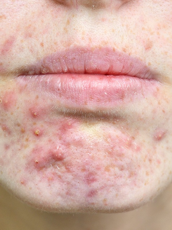Spironolactone an effective alternative to antibiotics for acne in