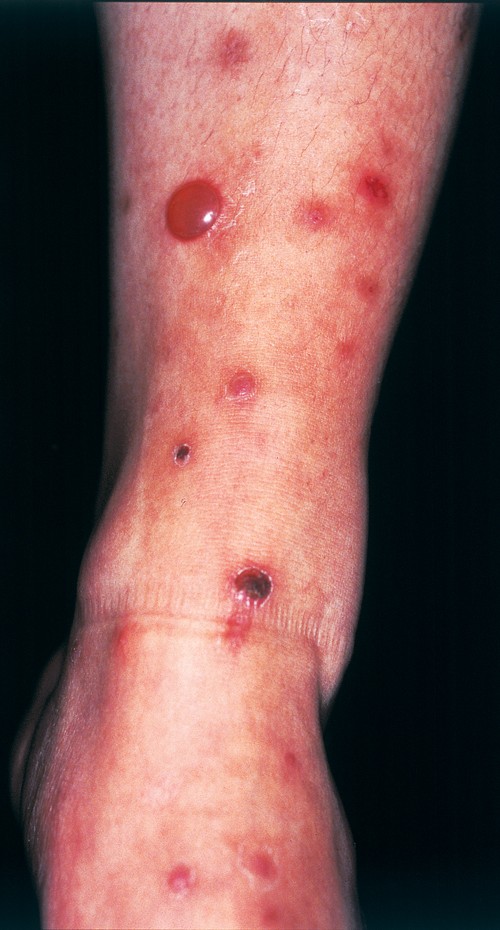 Blisters sales on legs