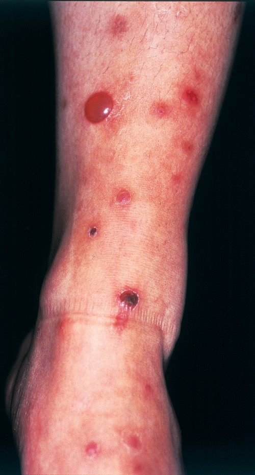 skin blisters