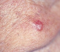 Nonmelanoma Skin Cancer: Update On Management | Medicine Today