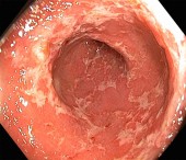 © GASTROLAB/SPL ULCERATIVE COLITIS