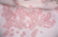 Fig 2. Tinea corporis