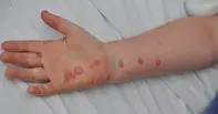 Fig 1a. Arm lesions Fig 1a. Arm lesions