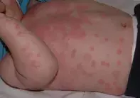 Fig 2. Urticaria Fig 2. Urticaria