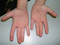 Fig 2. Itchy papules on palms