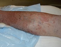Tinea corporis