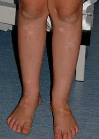Figure 5. Vitiligo.