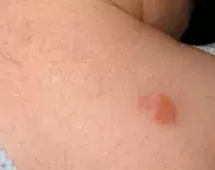 https://medicinetoday.com.au/sites/default/files/styles/dermatology_quiz/public/DermQu34-Fig1.jpg.webp?itok=jvj7_uPv