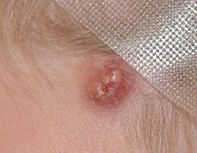 Fig 3. Pilomatrixoma.