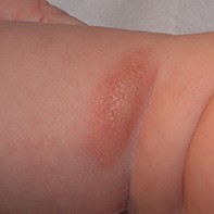 Fig 4. Mastocytoma.