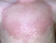 Rash.