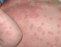 Urticaria.
