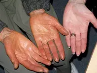 Orange discoloration of the palms