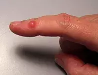 bump on finger