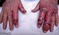 Fig 1. Hand lesions.