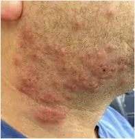 Tinea Barbae, Itching, Pustules