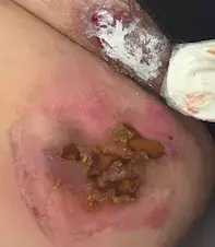 Skin condition in groin area : r/velvethippos