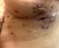 Skin condition in groin area : r/velvethippos