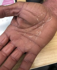 Fig 2. Palm.