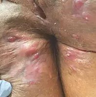 Chronic inflammatory nodules in the groin area