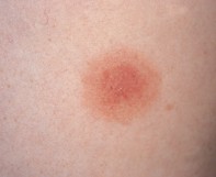 Fig 1. Erythematous lesion