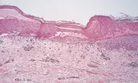 Fig 2. Lichenoid reaction