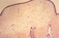 Fig 2. Dermal oedema