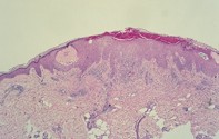 Fig 2. Serum and inflammation