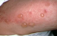 Fig 1. Tense blisters