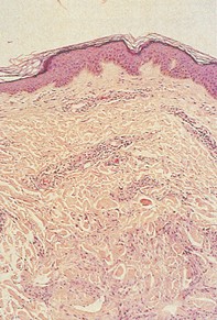 Fig 2. Histiocyte infiltrate