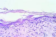 Fig 2. Atrophic epidermis