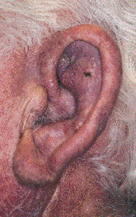 Fig 1. Dusky erythema