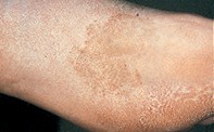 Fig 1. Tan patch