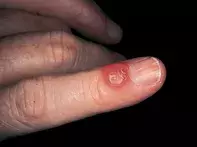 Fig 1. Translucent cyst