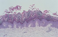 Fig 2. Papillomatous epidermis