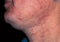 Fig 1. Irritable rash