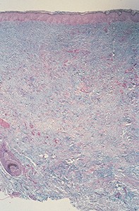 Fig 2. Abundant mucin