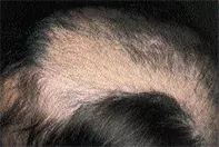 Fig 1. Alopecia