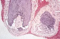 Fig 2. Scalp biopsy